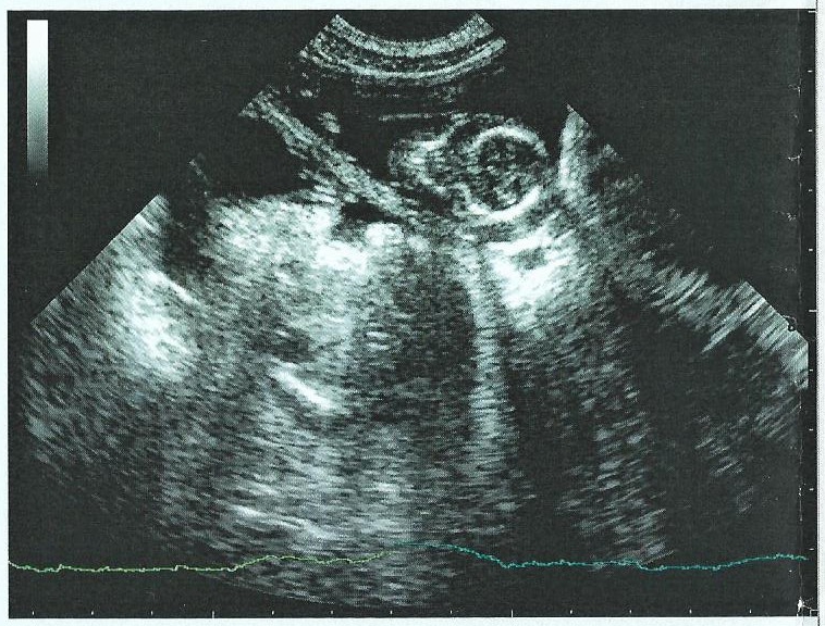 echo1.jpg - Echographie de contrôle, 6 semaines de gestation, là une tête vue de dessus !